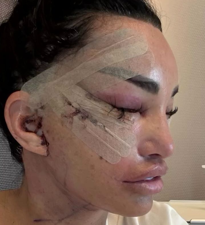 Katie Price in recovery from facelift